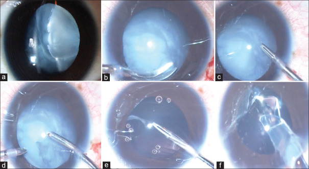 Pediatric cataract surgery in congenital anterior segment dysmorphology: An overview.