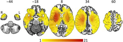 Frontoparietal Structural Network Disconnections Correlate With Outcome After a Severe Stroke