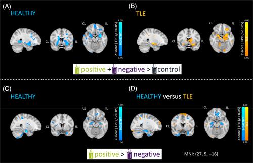 Olfactory Dysfunction and Limbic Hypoactivation in Temporal Lobe Epilepsy