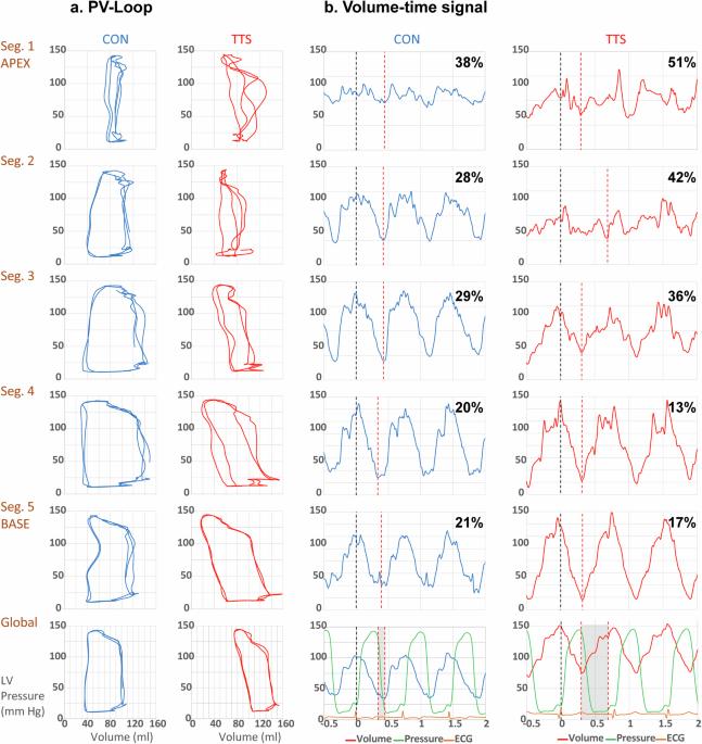 Regional mechanical dyssynchrony and shortened systole are present in people with Takotsubo syndrome