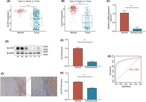 Downregulation of GLYAT correlates with tumour progression and poor prognosis in hepatocellular carcinoma