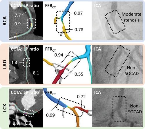 Impact of Heterogeneous Plaque Deposition on Computed Tomography Derived Fractional Flow Reserve