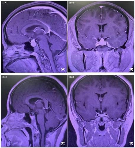 Pituitary hyperplasia secondary to primary hypothyroidism in adolescents: A medical case report and literature review