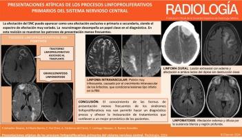 Presentaciones atípicas de los procesos linfoproliferativos primarios del sistema nervioso central