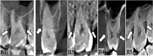 Evaluation of Alveolar Bone Destruction Patterns in the Posterior Region of the Maxilla Through Cone Beam Computer Tomography on 361 Consecutive Patients: Effect of Age and Gender