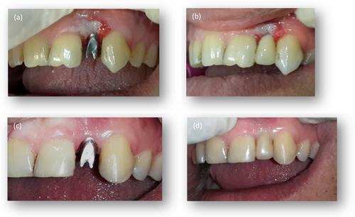 Prosthetic Soft Tissue Management in Esthetic Implant Restorations, Part I: Presurgical Planning, Implant Placement, and Restoration Timing. A Narrative Review