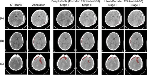 Automated Hematoma Detection and Outcome Prediction in Patients With Traumatic Brain Injury