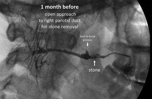 Parotid sialolithiasis – Long term follow-up analyzing surgical approaches