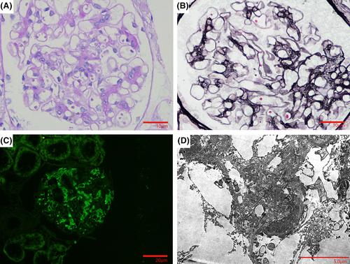 Coexisting nutcracker phenomenon and refractory hypertension in a patient with IgA nephropathy: A case report and literature review