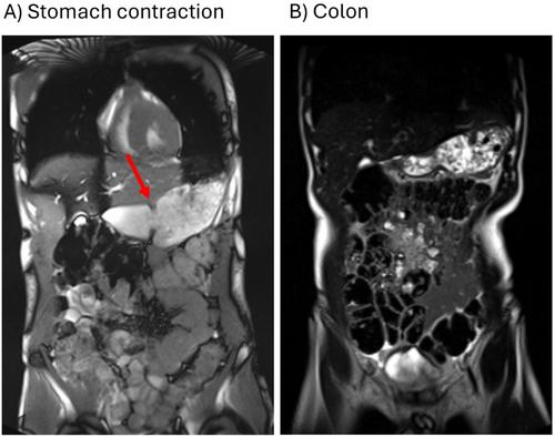 Pan-Alimentary Magnetic Resonance Imaging of Severe Gastroparesis May Facilitate Diagnosis and Treatment