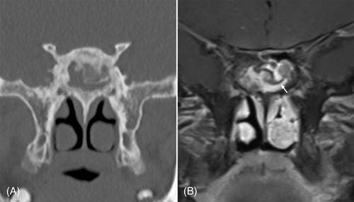 Causes and treatment of secondary sphenoid sinus infection post-endoscopic transsphenoidal approach