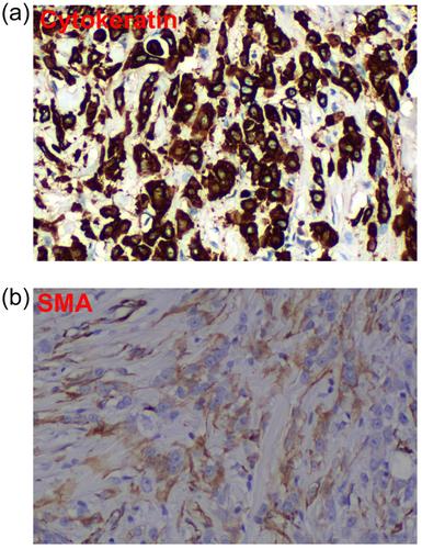 A rare primary cutaneous myoepithelial carcinoma in the axilla accompanied by lymph node metastasis: A case report