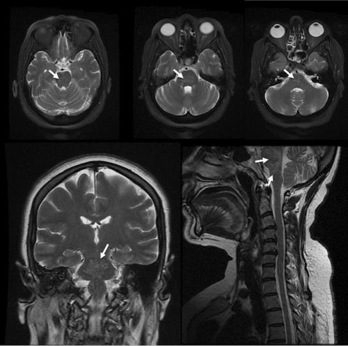 Navigating the Mysteries of CLIPPERS Syndrome: A Case Report of Long-Term Follow-Up