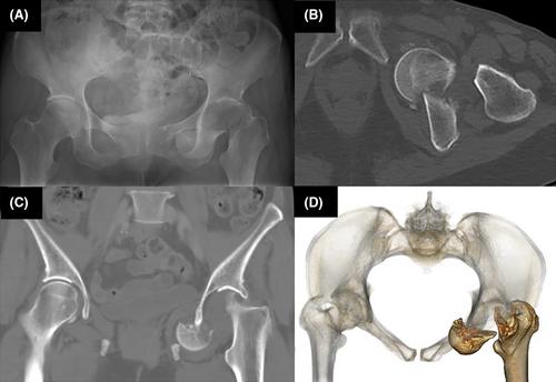 Obturator dislocation of hip with femoral neck fracture