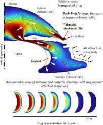 Drug delivery from a ring implant attached to intraocular lens: An in-silico investigation