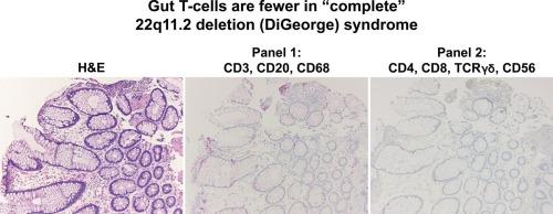 T-cells are significantly reduced in the luminal gastrointestinal tract of patients with “complete” 22q11.2 deletion syndrome (DiGeorge syndrome): Utilization of chromogenic multiplex immunohistochemistry to define cellular populations