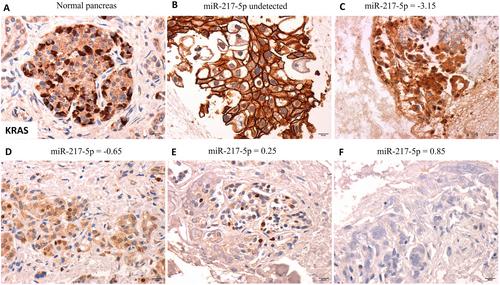 Analysis of Candidate miRNAs' Expression in Pancreatic Cancer