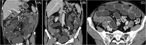 Older man with chronic right upper quadrant pain and vomiting