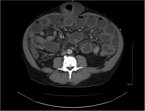 Point-of-care ultrasound identifies surgical emergency, expediting care