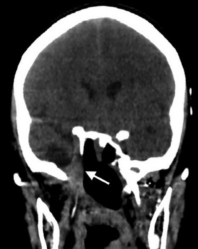 Complication of post-lumbar puncture