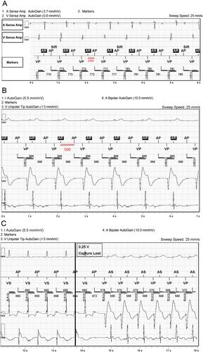 Introducing a Novel Pacemaker-Mediated Arrhythmia: The Pseudo-RNRVAS Arising From Atrial Capture Challenges.