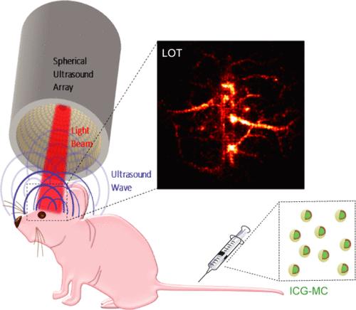 Super-resolution Optoacoustic Imaging of Cerebral Microcirculation with Indocyanine Green Microcapsules