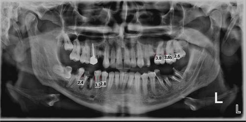 Evaluation of Panoramic Radiography Diagnostic Accuracy in the Assessment of Interdental Alveolar Bone Loss Using CBCT