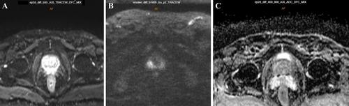 Optimizing Multiparametric MRI Protocols for Prostate Cancer Detection: A Comprehensive Assessment Aligned with PI-RADS Guidelines