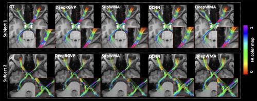 Tractography-Based Automated Identification of Retinogeniculate Visual Pathway With Novel Microstructure-Informed Supervised Contrastive Learning