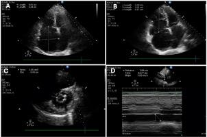 Severe Tricuspid Regurgitation Leads to Underestimation of the Severity of Mitral Stenosis by Doppler