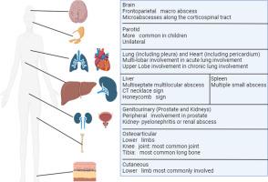 Abscesses due to Melioidosis: A case-based review