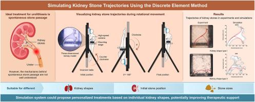 Discrete element method-based simulation system for predicting natural stone evacuation pathways in patients with urolithiasis