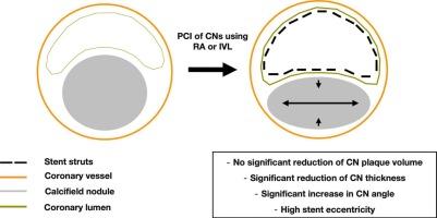 Comparison of interventional treatment options for coronary calcified nodules: A sub-analysis of the ROTA.shock trial