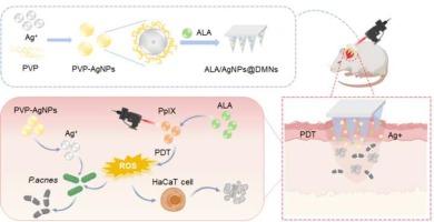 Light-responsive antibacterial dissolving microneedles loaded with 5-aminolevulinic acid and silver nanoparticles for the treatment of acne