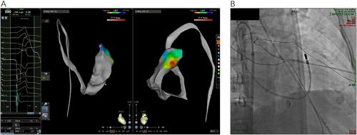 Catheter Ablation of Ventricular Premature Contractions Originating From RVOT With Interruption of the Inferior Vena Cava—A Case Report