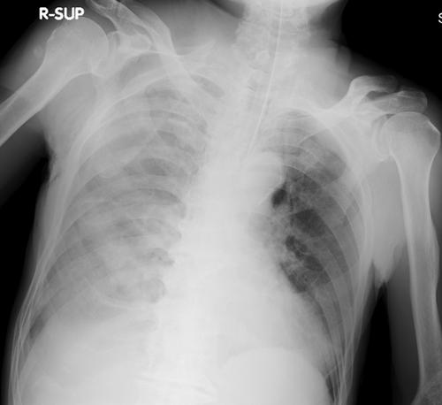 Cardiac rupture caused by penetration of the heart by fractured costal cartilage following blunt chest trauma: A case report