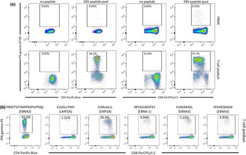 Autologous Epstein–Barr virus-specific adoptive T-cell therapy in a patient with lupus nephritis