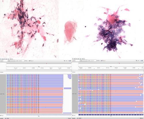 Unveiling Diagnostic Clues of NTRK-Rearranged Spindle Cell Neoplasms in Fine-Needle Aspiration Specimens