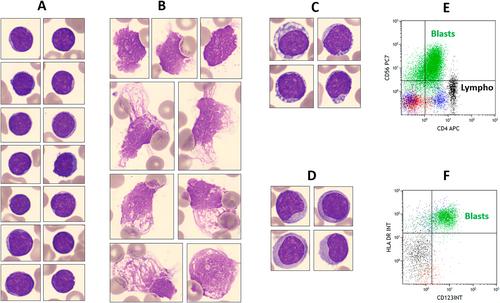 Blastic Plasmocytoid Dendritic Cell Neoplasm With Pseudo-Lymphoid Morphology Mimicking Lymphoid Malignancy