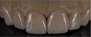 A review, zirconia based dental materials