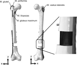 An Overview of Design and Development of Biomimetic Bone Scaffolds Using Heterogeneous TPMS Lattice Structures