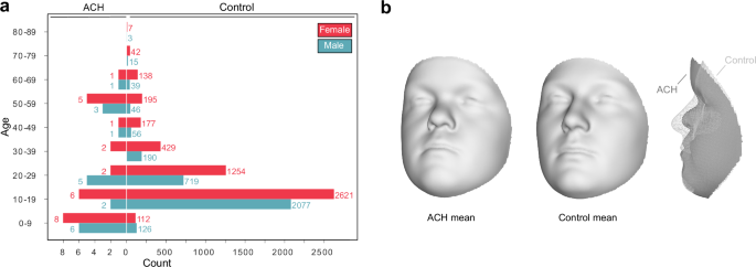 Syndrome-informed phenotyping identifies a polygenic background for achondroplasia-like facial variation in the general population