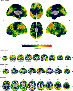 Cortical hypometabolism in Parkinson’s disease is linked to cholinergic basal forebrain atrophy