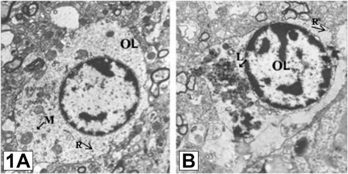 Glial cell deficits are a key feature of schizophrenia: implications for neuronal circuit maintenance and histological differentiation from classical neurodegeneration