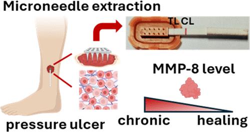 Integrated 3D-Printed Hollow Microneedle Array and Lateral Flow Immunoassay for Point-of-Care Wound Healing Monitoring