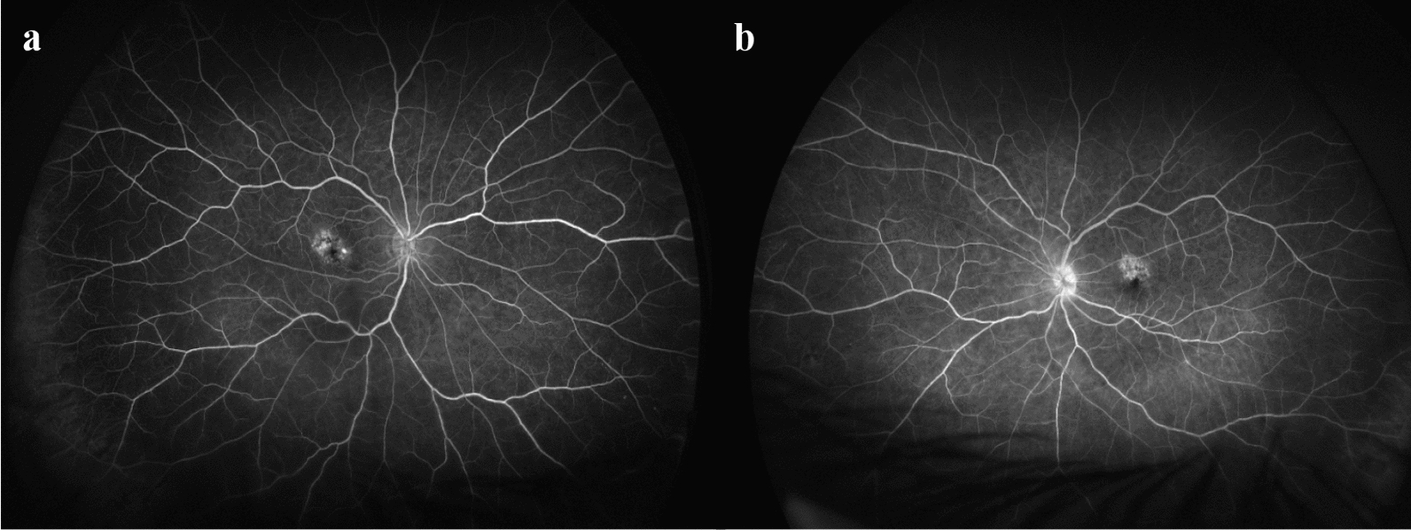 Bilateral occlusive retinal vasculitis secondary to intravitreal faricimab injection: a case report and review of literature.