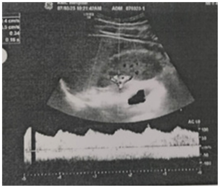 A case of a young man with secondary hypertension.