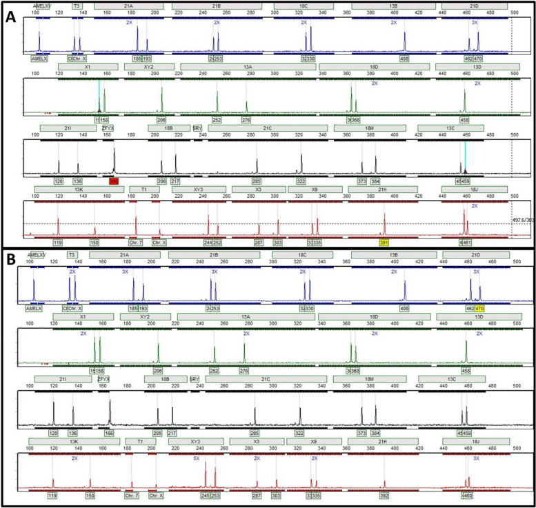 Diploid fetus with partially triploid placenta: case presentation and management strategy.