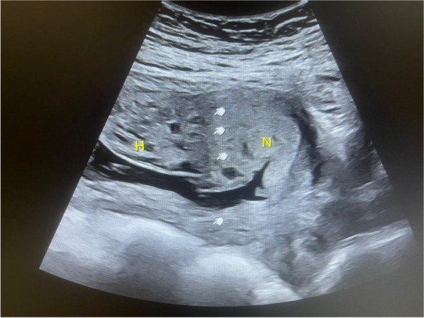Diploid fetus with partially triploid placenta: case presentation and management strategy.