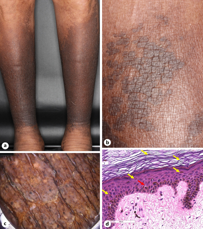 Atypical Bilateral Hyperpigmented Macules on the Lower Legs Possibly due to Cyclophosphamide.